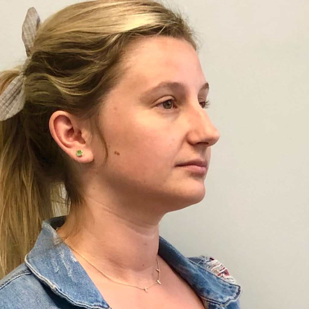 Young woman nose job with bone and nasal tip custom Rhinoplasty pre operative side view – pre op oblique blonde